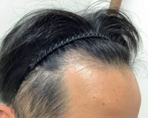 AGA治療前＿25歳男性＿生え際・頭頂部の薄毛＿広島院