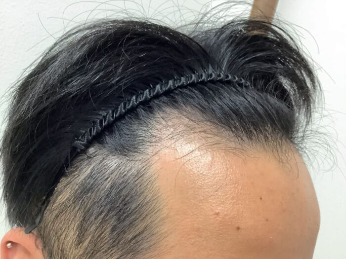 【25歳男性】生え際・頭頂部の薄毛がAGA治療で改善｜広島院