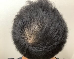 AGA治療前＿33歳男性＿生え際・頭頂部の薄毛＿広島院