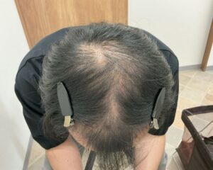 AGA治療前＿49歳男性＿生え際・頭頂部の薄毛＿広島院
