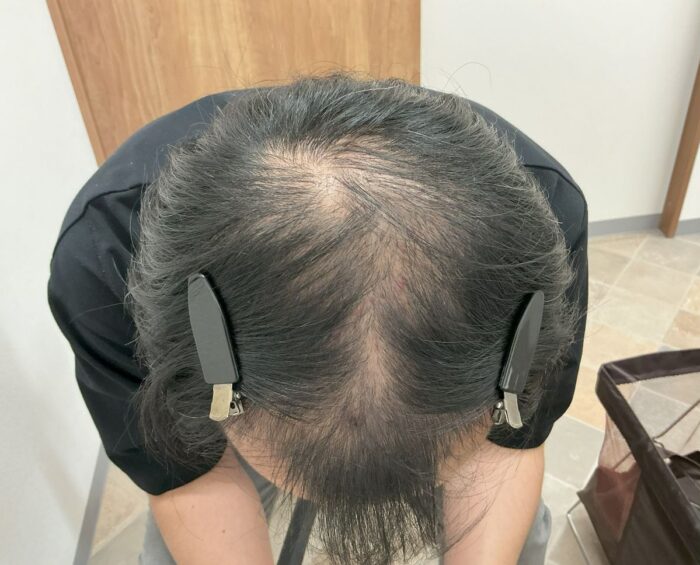 【49歳男性】生え際・頭頂部の薄毛がAGA治療で改善｜広島院