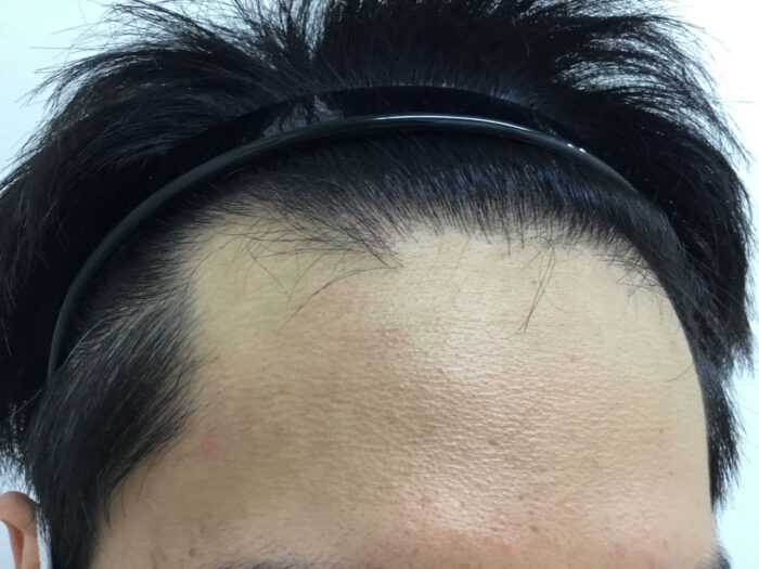 【29歳男性】生え際の薄毛がAGA治療で改善｜大阪梅田院