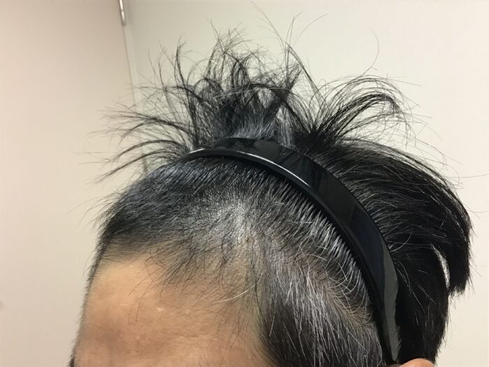 AGA治療開始約2ヶ月後 48歳男性 M字発毛 鹿児島院