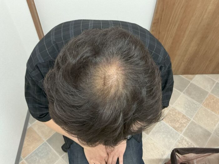 ＡＧＡ治療後＿53歳男性＿生え際・頭頂部の改善＿広島院